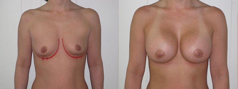 Breast Augmentation 0060
