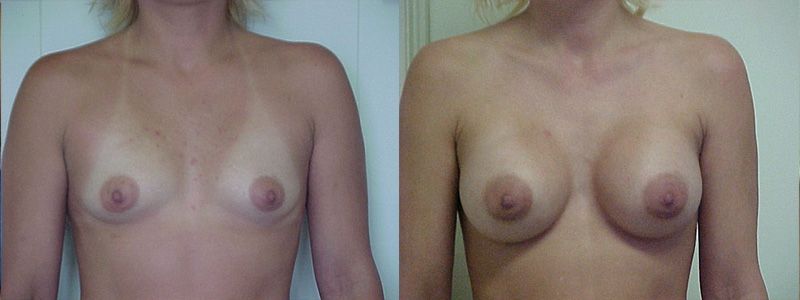 Breast Augmentation 0444