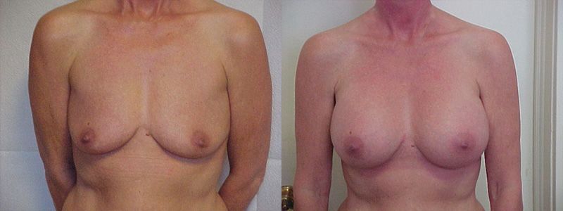 Breast Augmentation 0537