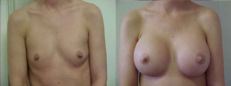 Breast Augmentation 0829