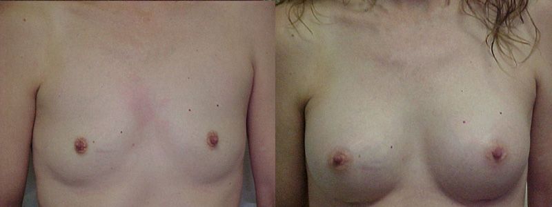 Breast Augmentation 0927