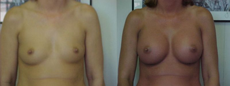 Breast Augmentation 1116