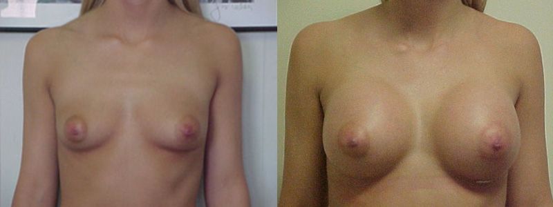 Breast Augmentation 1213