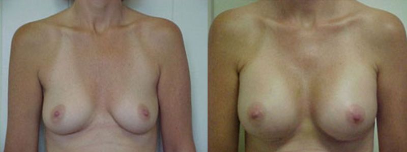 Breast Augmentation 1806