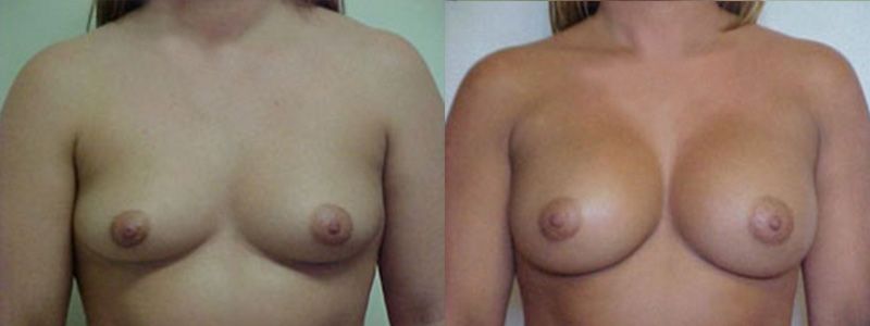 Breast Augmentation 1905