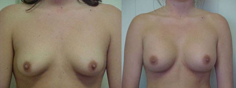 Breast Augmentation 2103