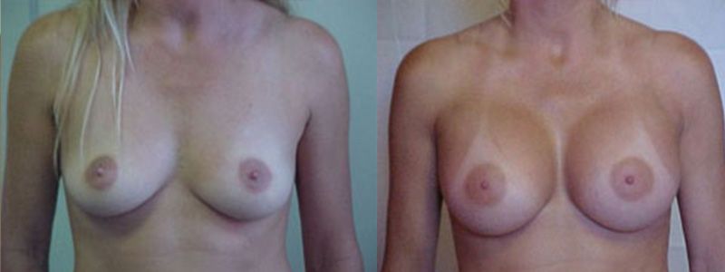 Breast Augmentation 2202