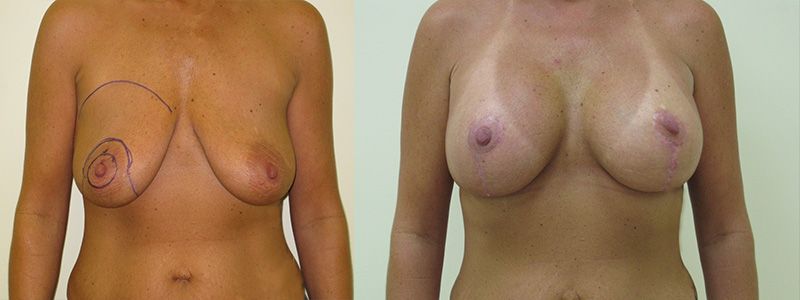 Breast Lift 2