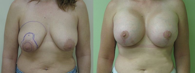 Breast Lift 3