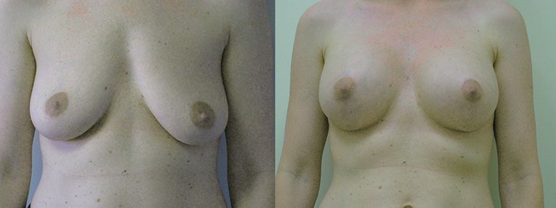 Breast Lift 4