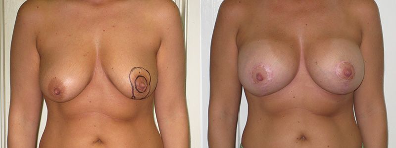Breast Lift 7