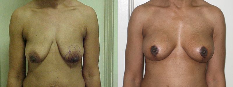 Breast Lift 8