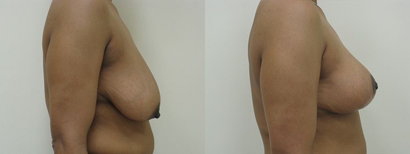 Breast Reduction 3.3