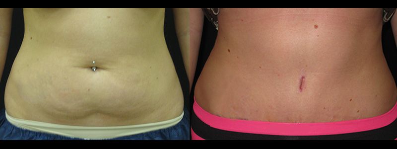 Tummy Tuck 00.1