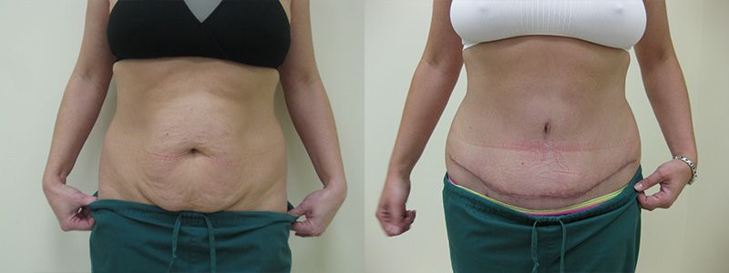 Tummy Tuck 01.2