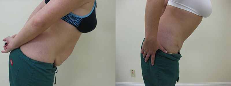 Tummy Tuck 01.3
